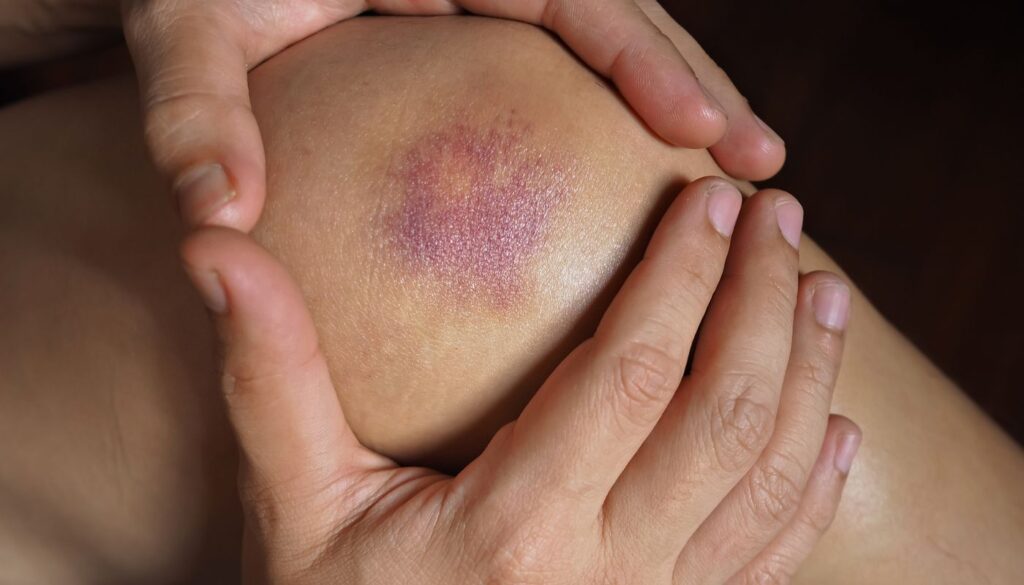 injury, swelling, pain and discoloration, use essential oils for bruising